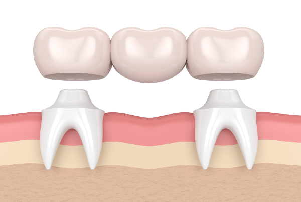 Fixed Prosthodontics