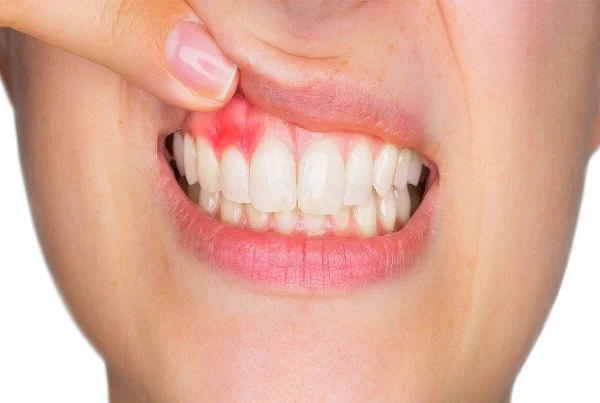 Gum Surgery